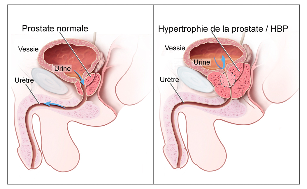 Schéma prostate