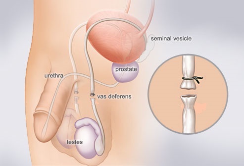 Schéma vasectomie