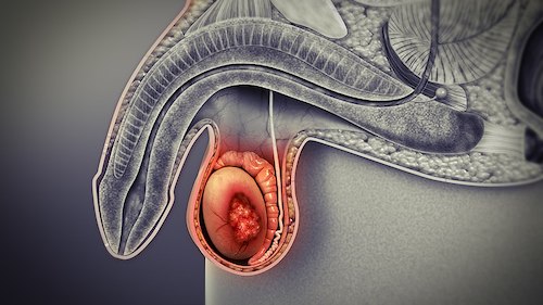 Cancer du testicule | UROSUD