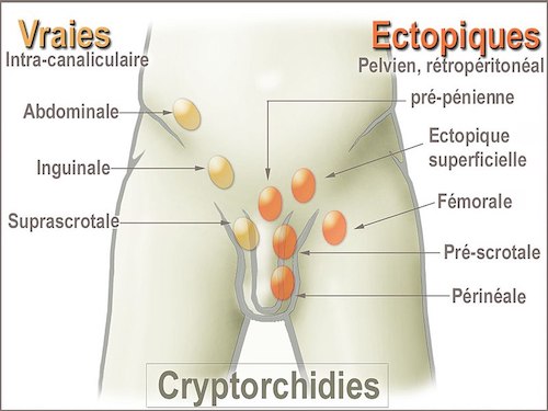 Testicule non descendu schéma