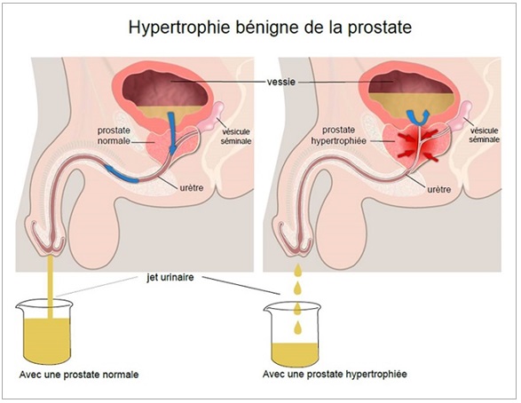 Schéma prostate