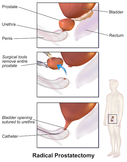 Schéma traitement cancer prostate
